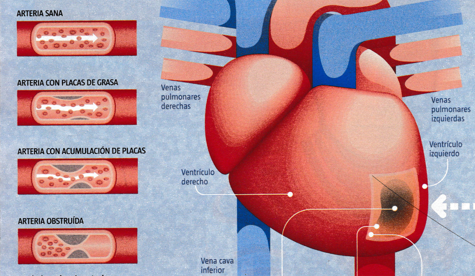 Infarto: un gran problema sanitario